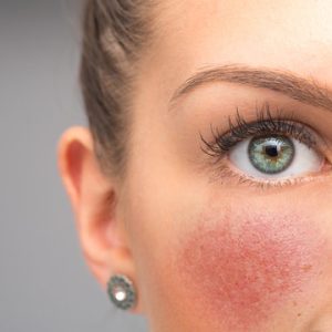 rosacea